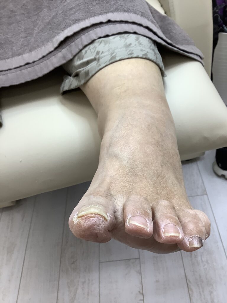 巻きが強くても アフター