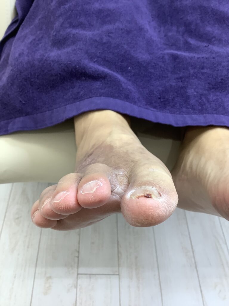 切りすぎた爪 ビフォー