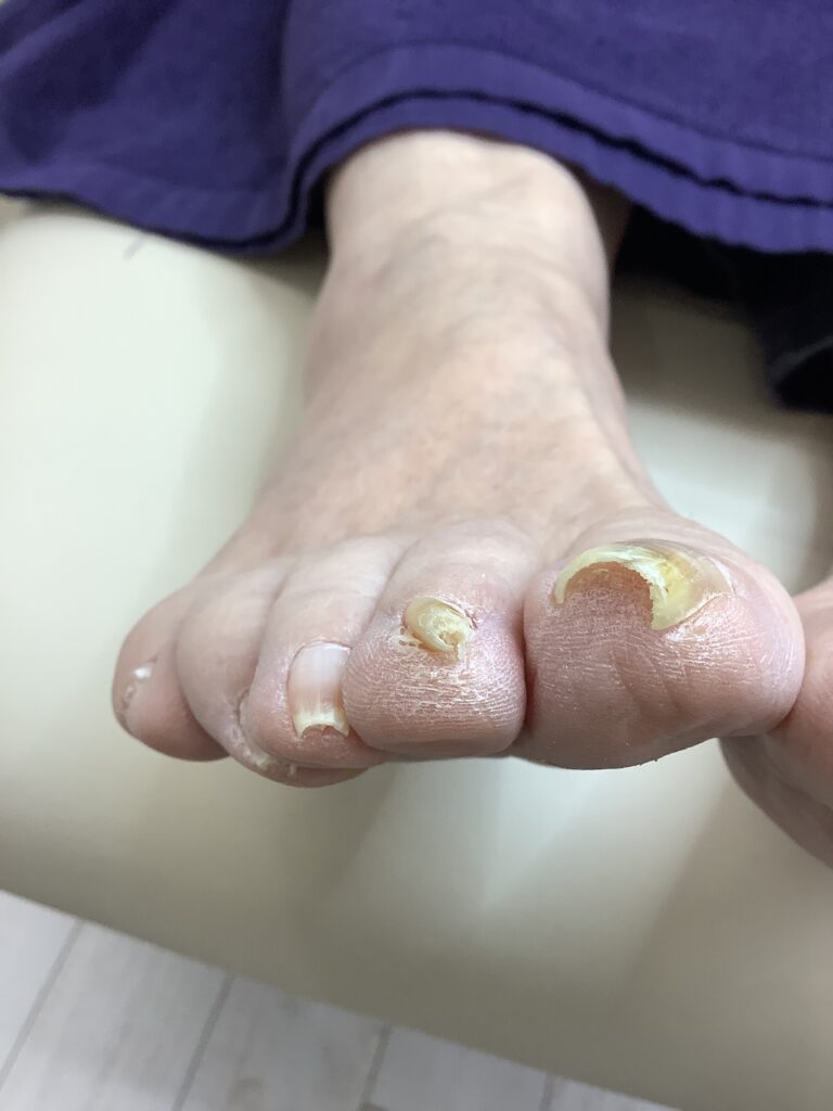 小さい爪でも ビフォー