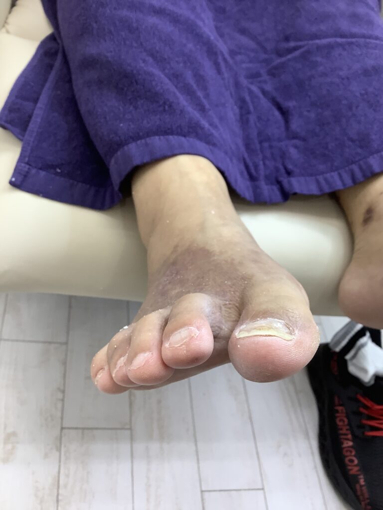 切りすぎた爪 アフター