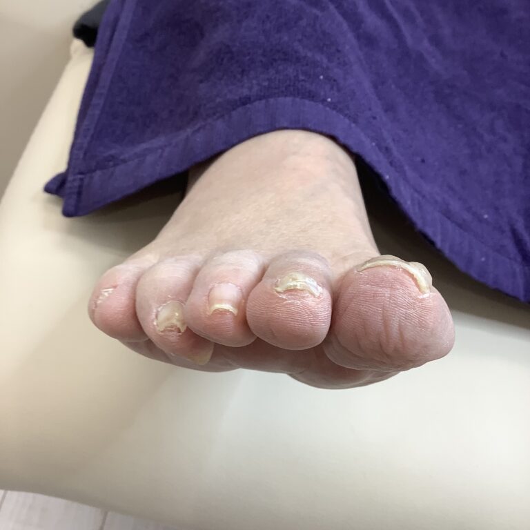 小さい爪でも アフター
